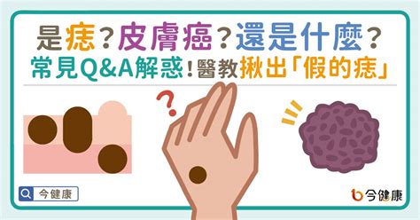 長毛痣|是痣？還是皮膚癌？皮膚科醫師教你揪出「假的痣」，。